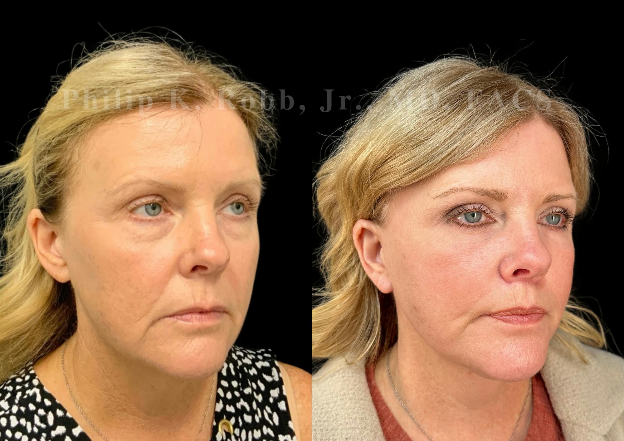 Neck Lift Before & After Gallery - Patient 306570 - Image 5