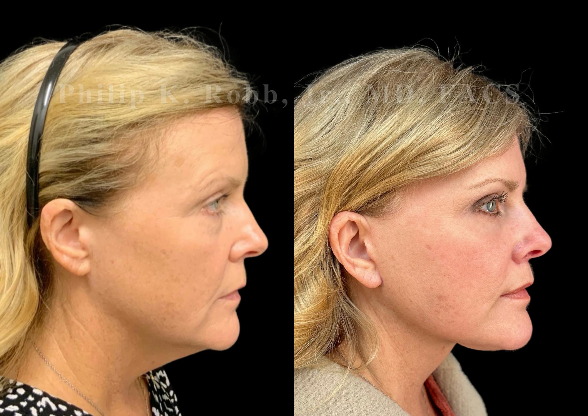 Neck Lift Before & After Gallery - Patient 306570 - Image 6