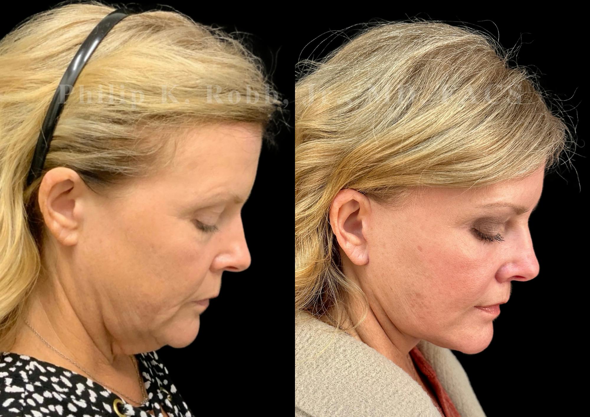 Neck Lift Before & After Gallery - Patient 306570 - Image 7