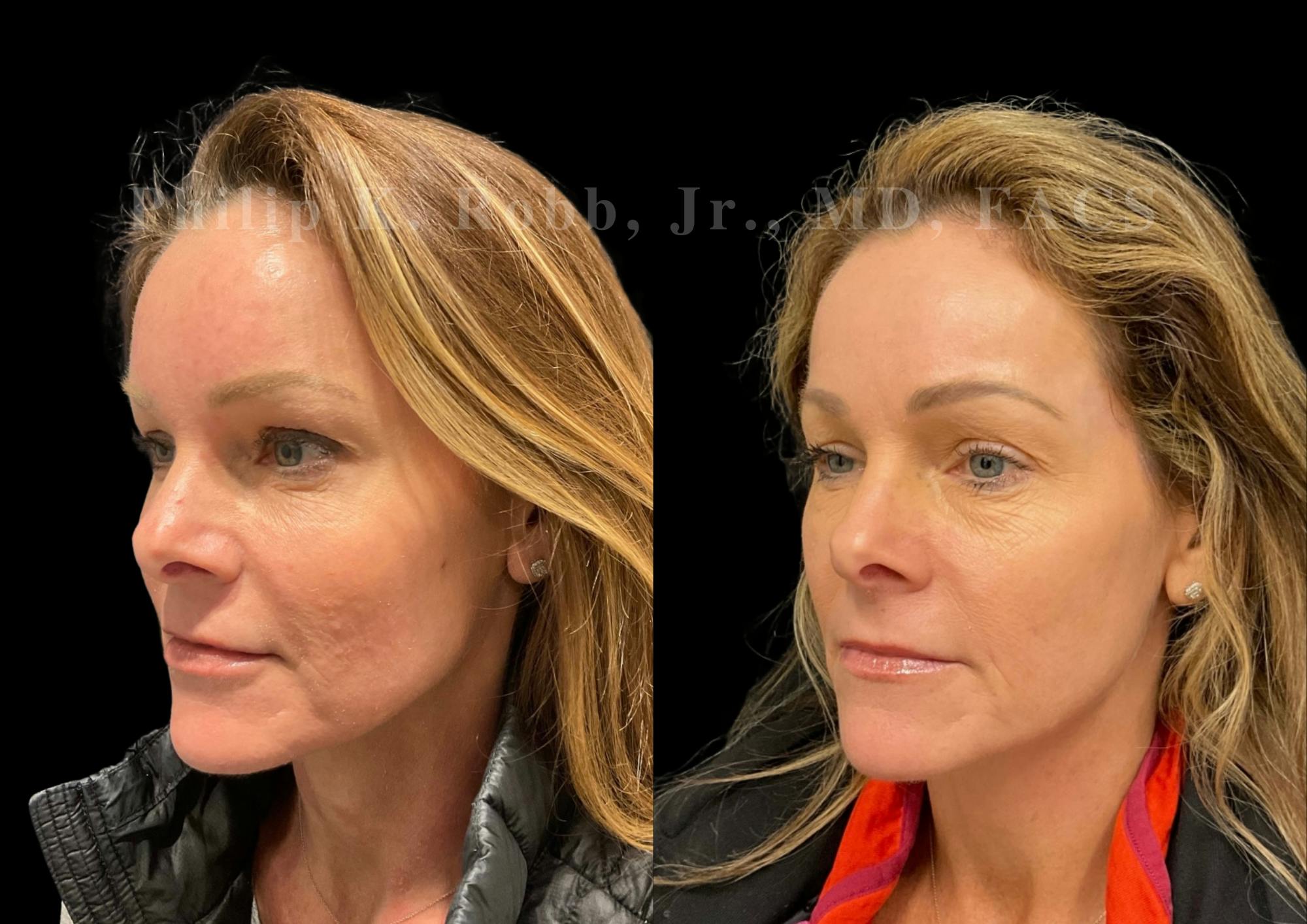 Laser Skin Resurfacing Before & After Gallery - Patient 217844 - Image 2