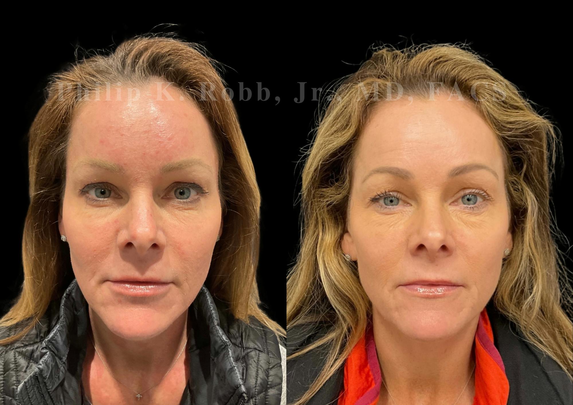 Laser Skin Resurfacing Before & After Gallery - Patient 217844 - Image 1