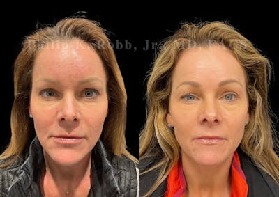 Laser Skin Resurfacing Before & After Gallery - Patient 217844 - Image 1