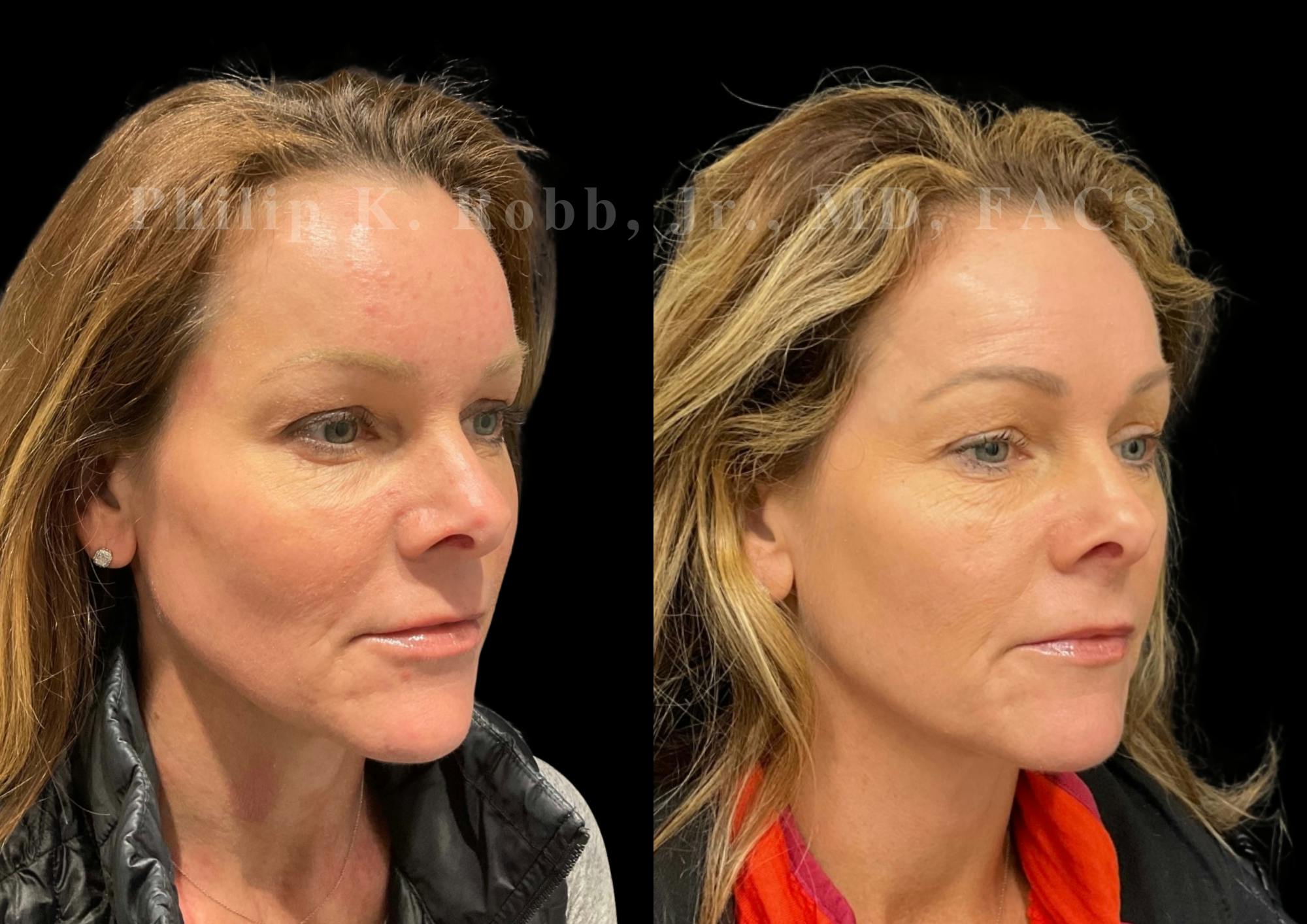 Laser Skin Resurfacing Before & After Gallery - Patient 217844 - Image 3