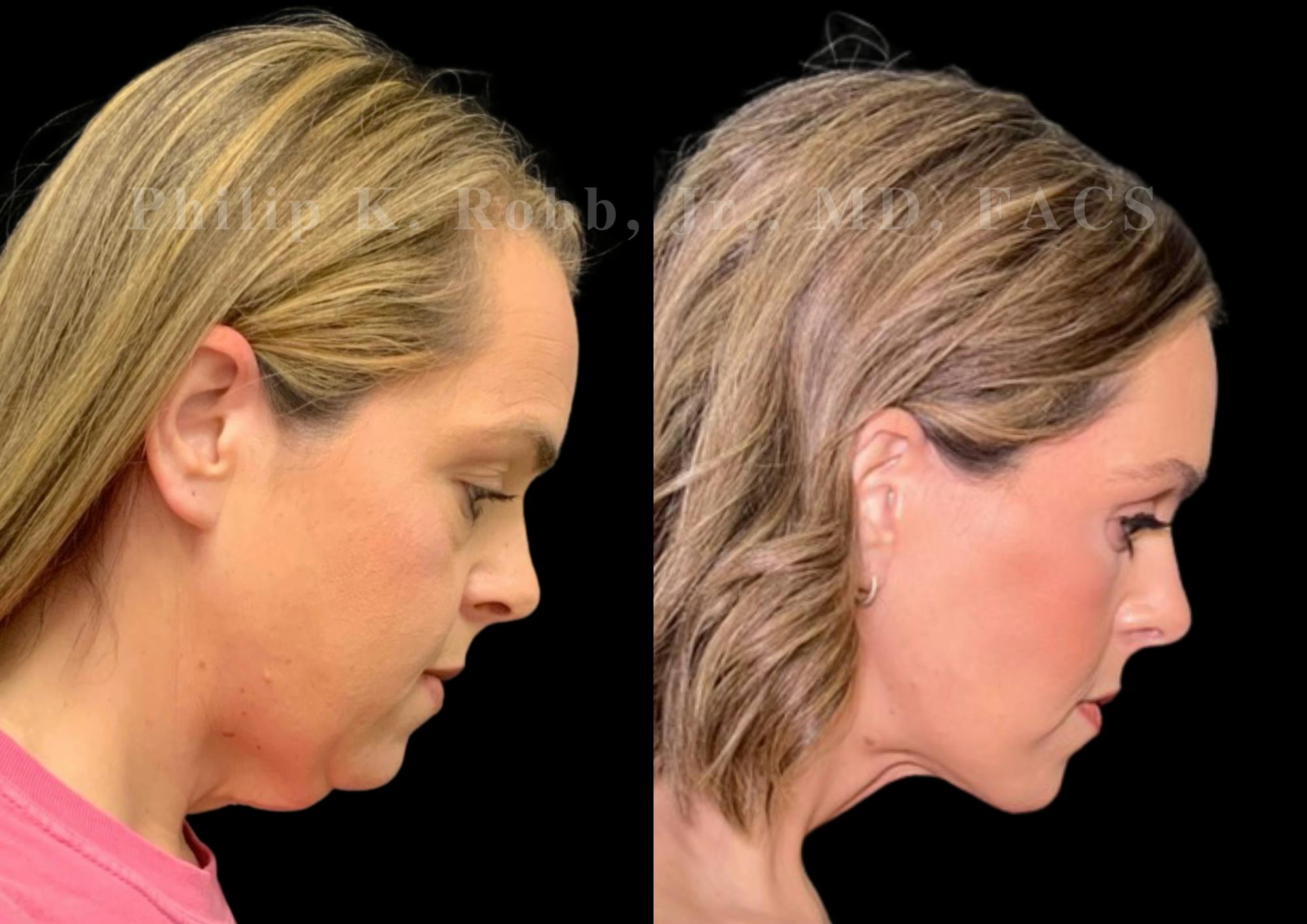 Neck Lift Before & After Gallery - Patient 256534 - Image 7