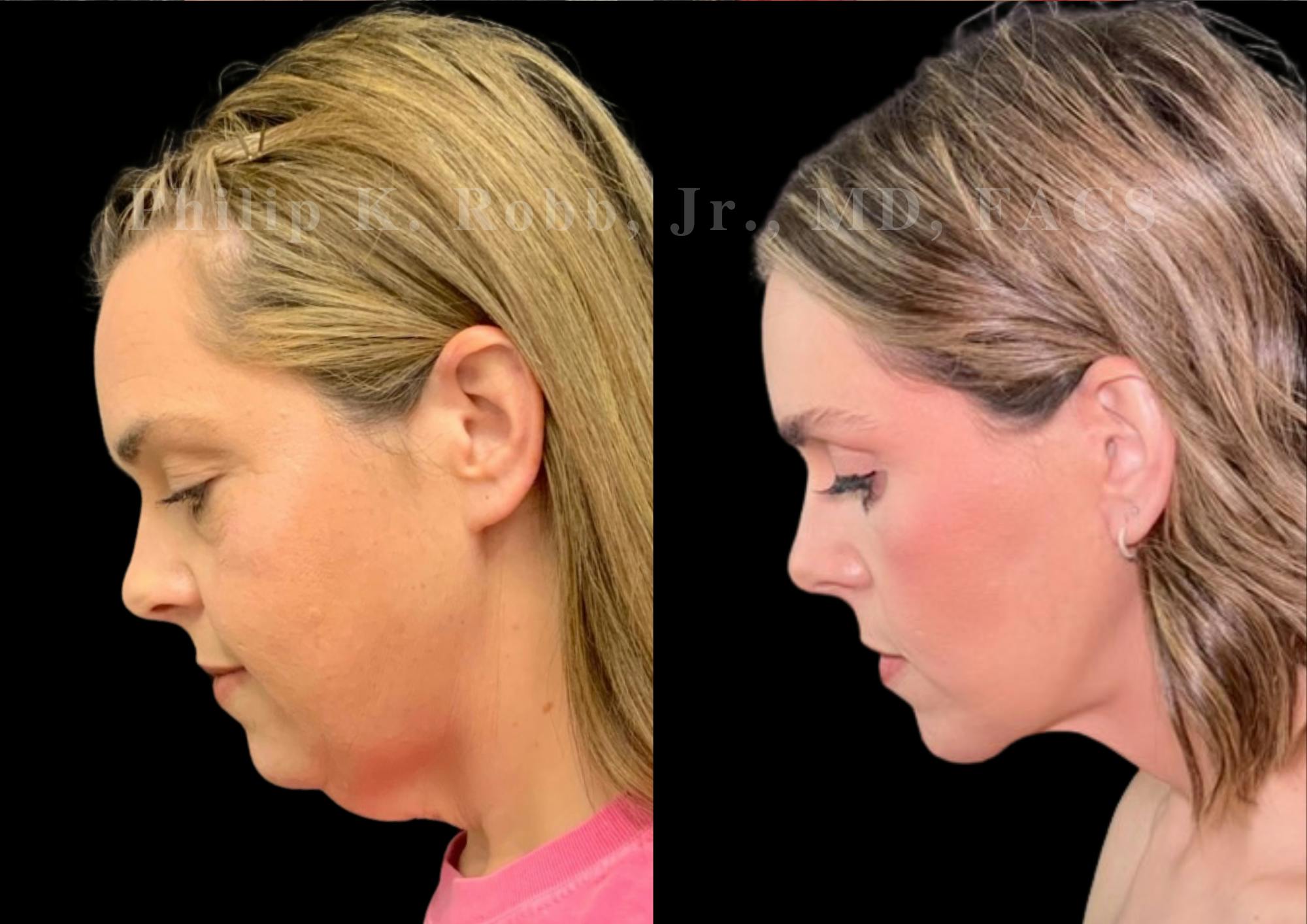 Neck Lift Before & After Gallery - Patient 256534 - Image 2