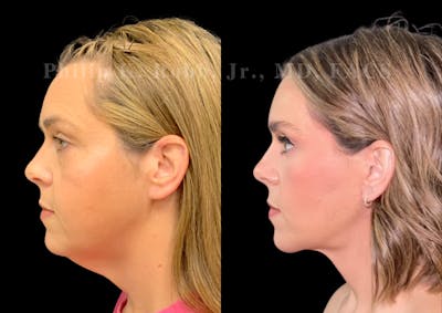 Neck Lift Before & After Gallery - Patient 256534 - Image 1