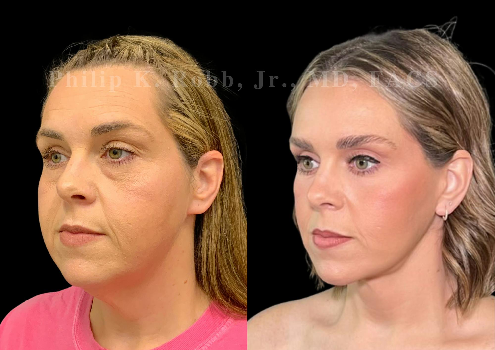 Neck Lift Before & After Gallery - Patient 256534 - Image 3