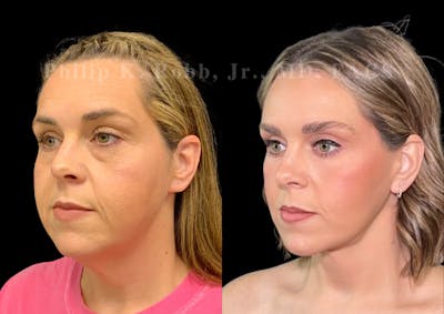 Facelift Before & After Gallery - Patient 224323 - Image 1