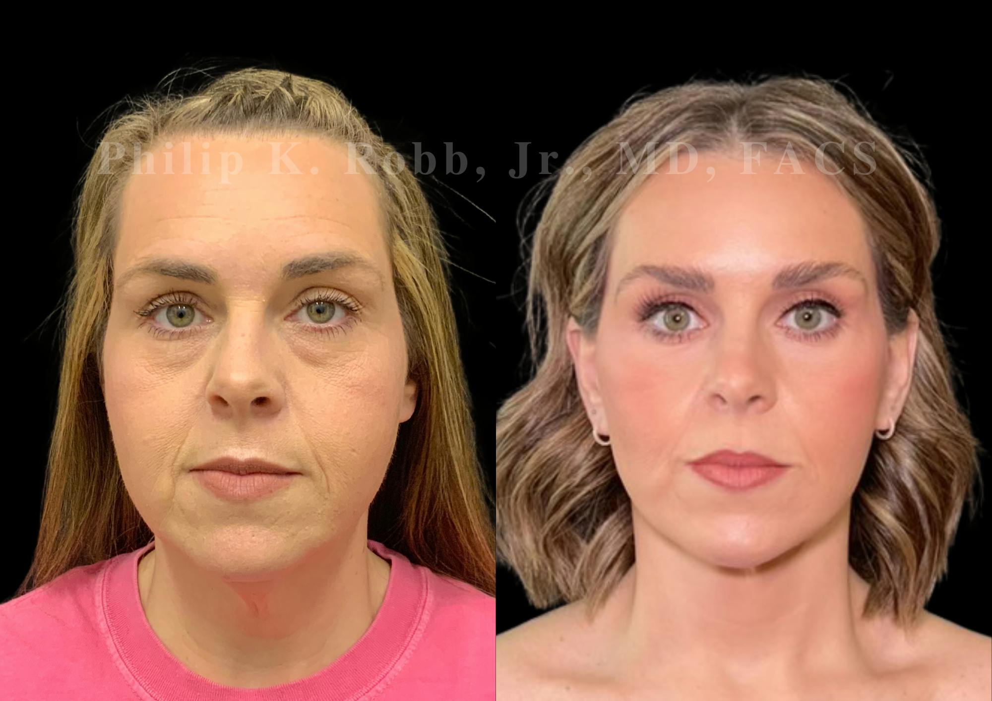 Neck Lift Before & After Gallery - Patient 256534 - Image 4