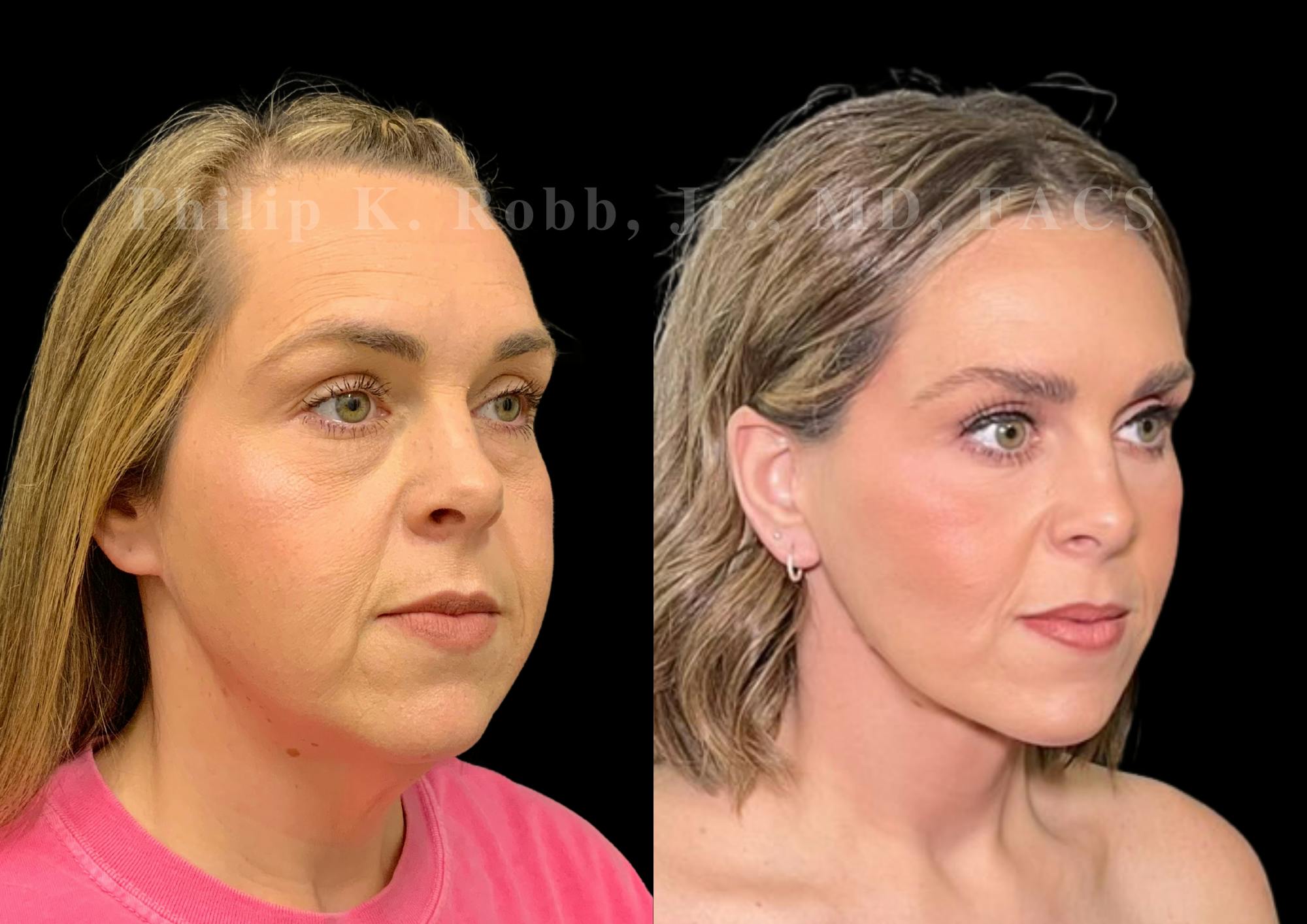Neck Lift Before & After Gallery - Patient 256534 - Image 5