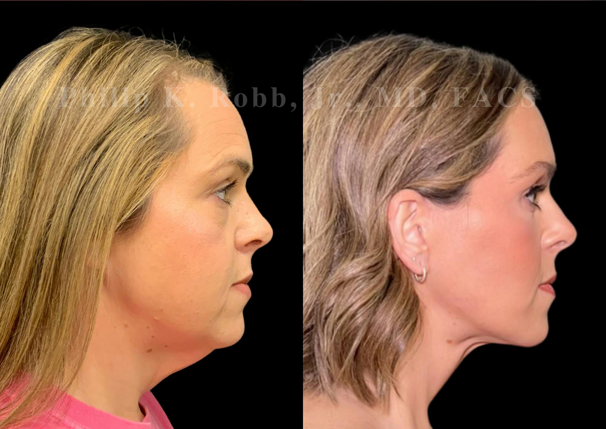 Neck Lift Before & After Gallery - Patient 256534 - Image 6