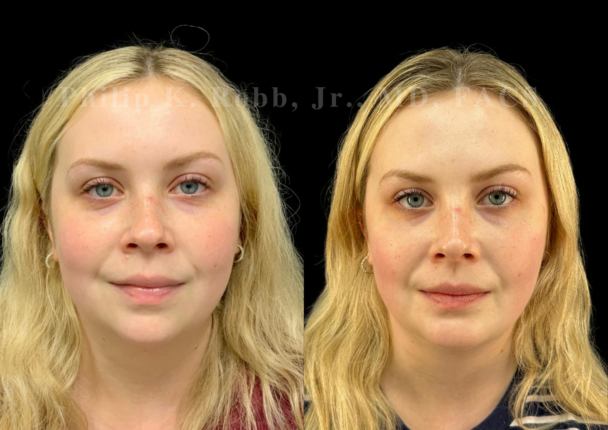 Chin Augmentation Before & After Gallery - Patient 217546 - Image 3
