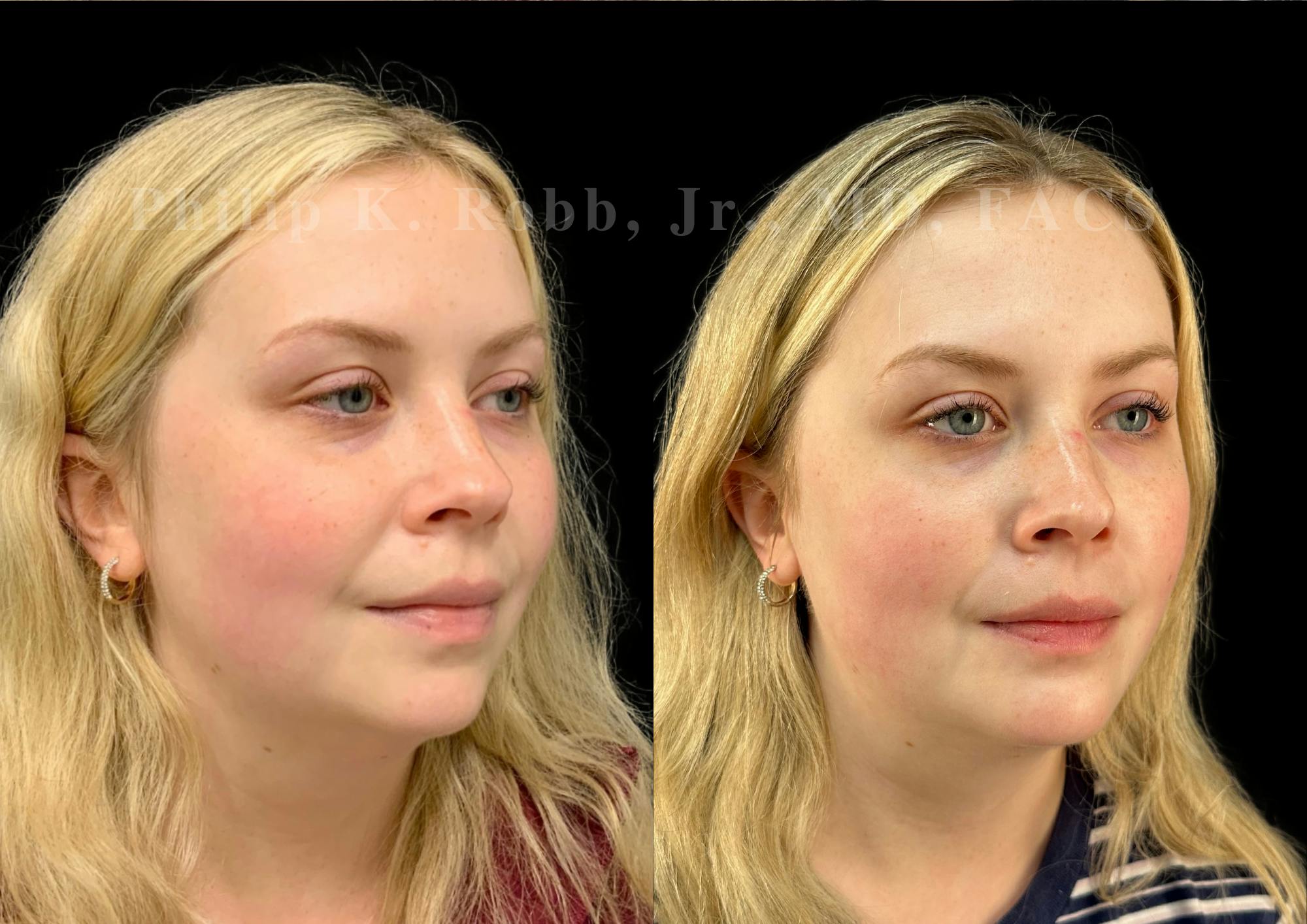 Chin Augmentation Before & After Gallery - Patient 217546 - Image 4