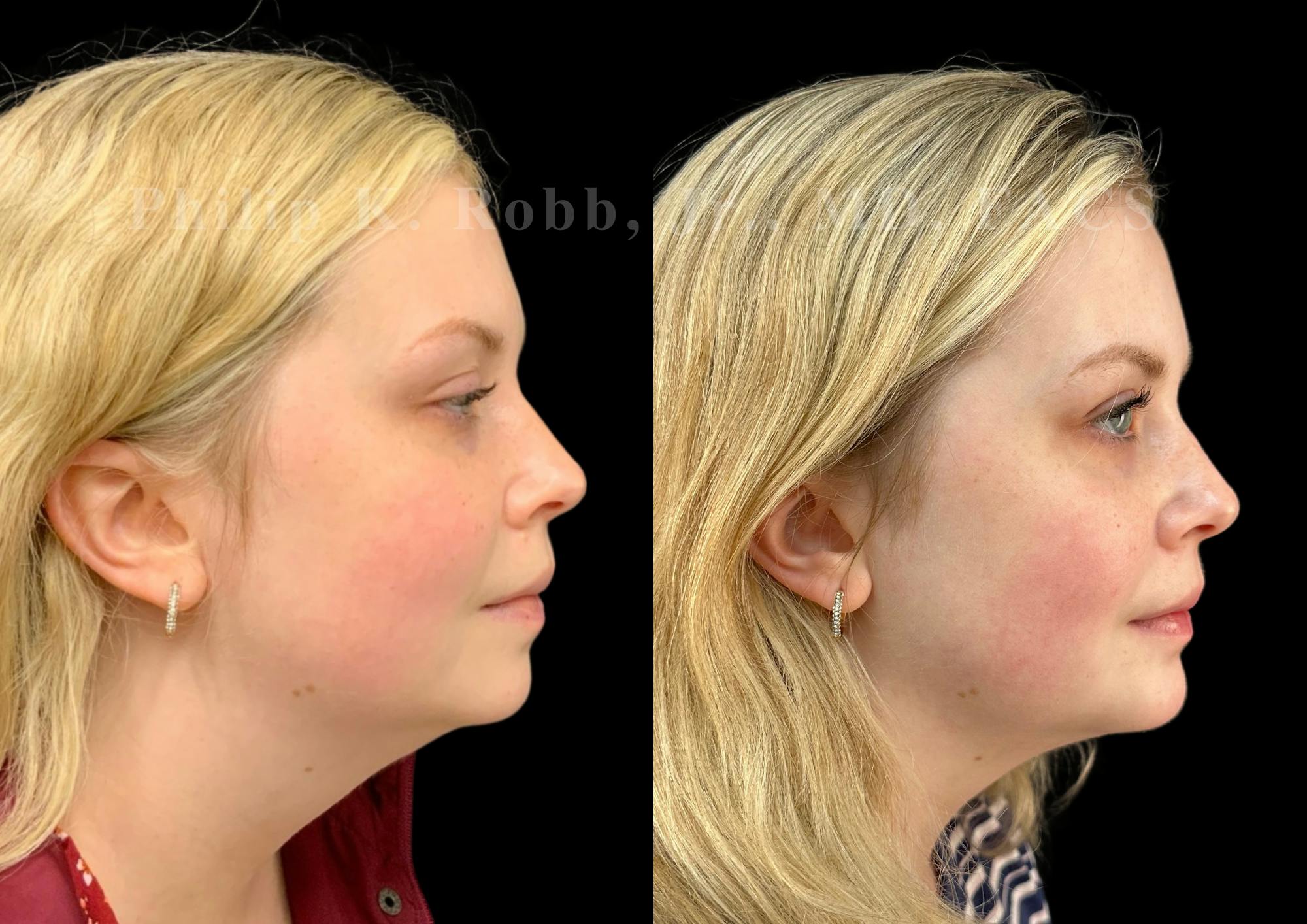 Chin Augmentation Before & After Gallery - Patient 217546 - Image 5