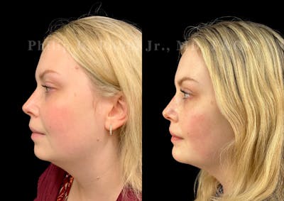 Chin Augmentation Before & After Gallery - Patient 217546 - Image 1