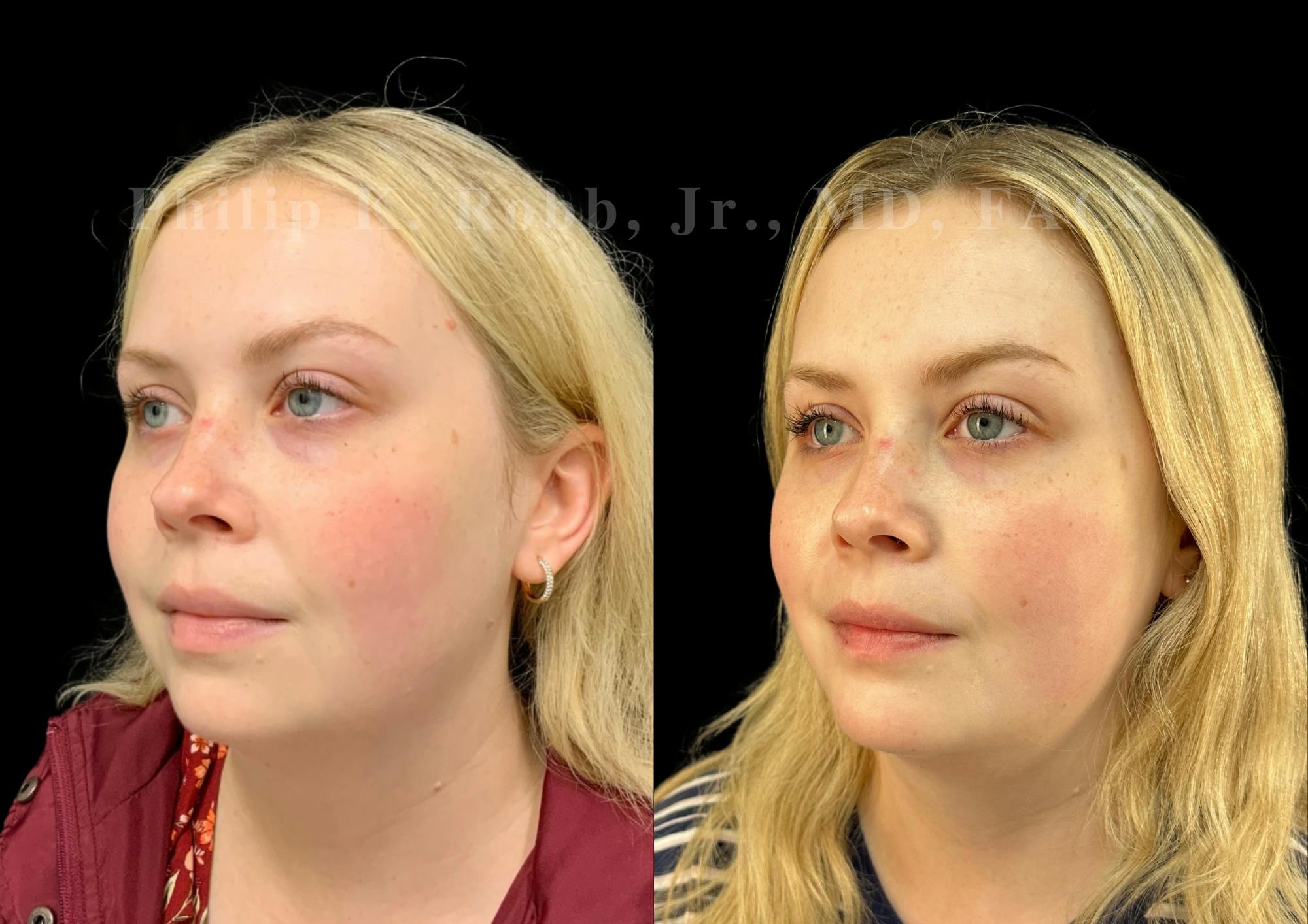 Chin Augmentation Before & After Gallery - Patient 217546 - Image 2
