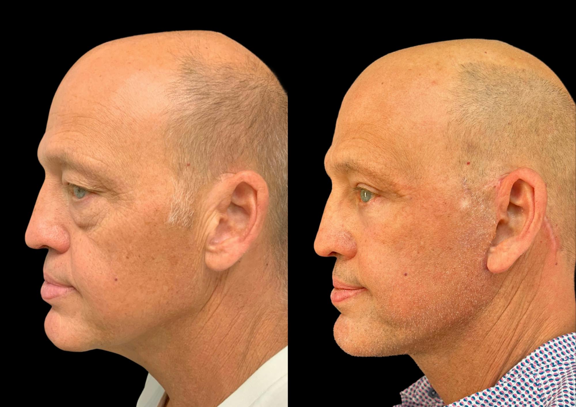Neck Lift Before & After Gallery - Patient 257148 - Image 1