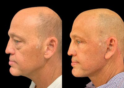 Neck Lift Before & After Gallery - Patient 257148 - Image 1