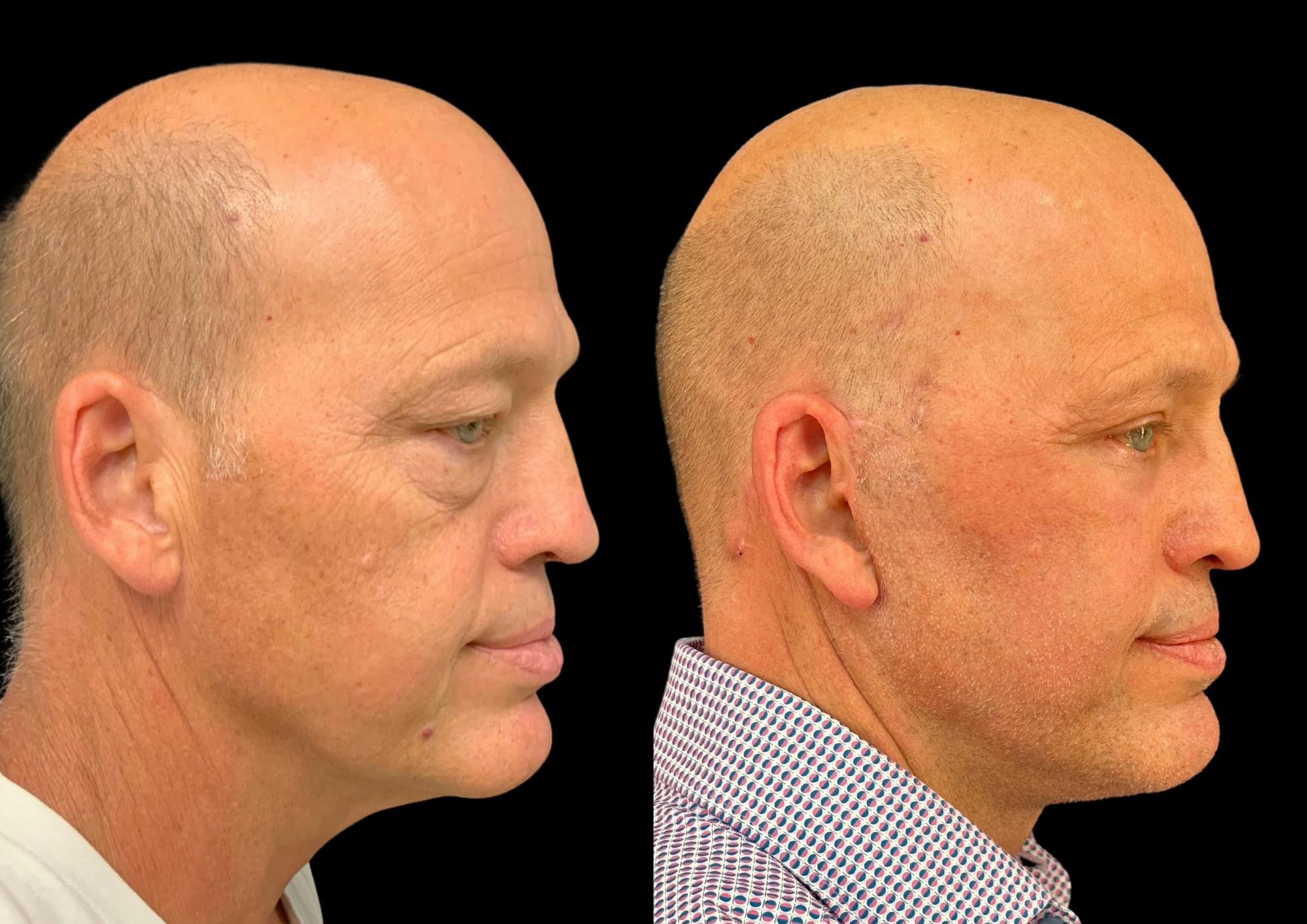 Neck Lift Before & After Gallery - Patient 257148 - Image 6