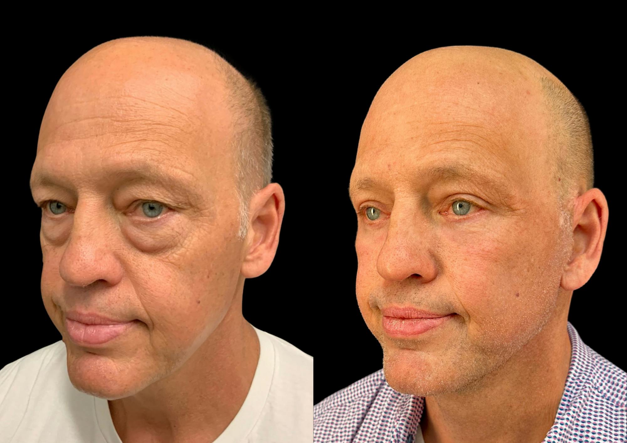 Neck Lift Before & After Gallery - Patient 257148 - Image 3