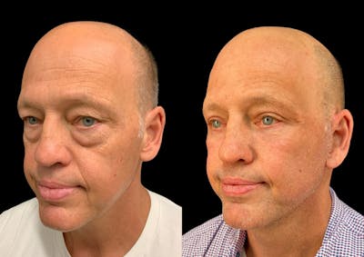 Facelift Before & After Gallery - Patient 571928 - Image 1