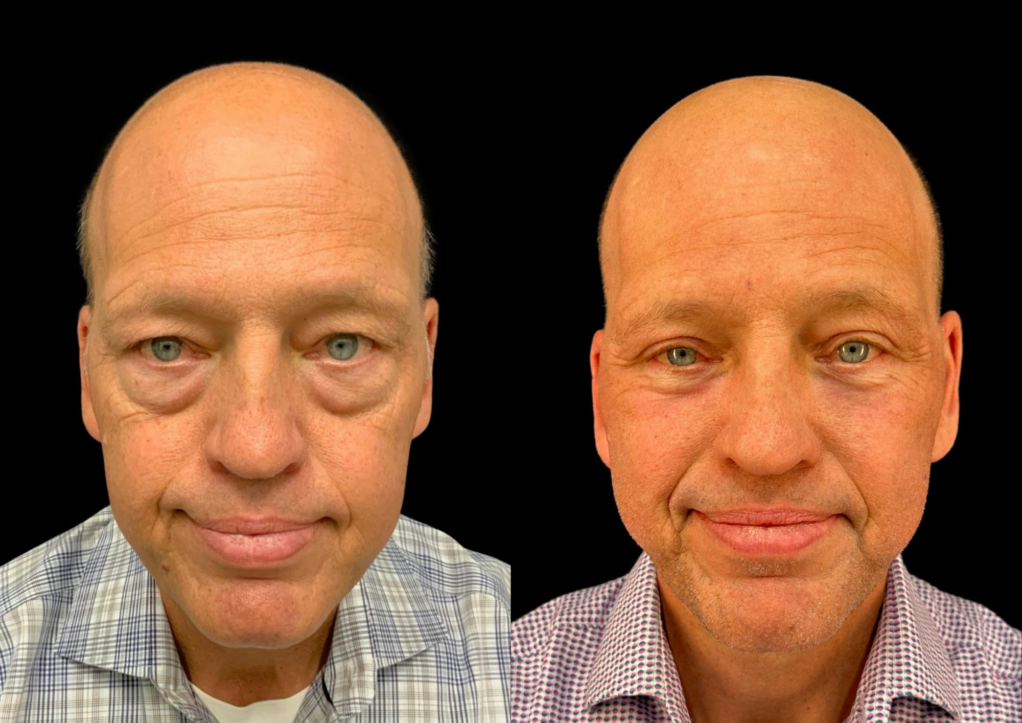 Neck Lift Before & After Gallery - Patient 257148 - Image 4
