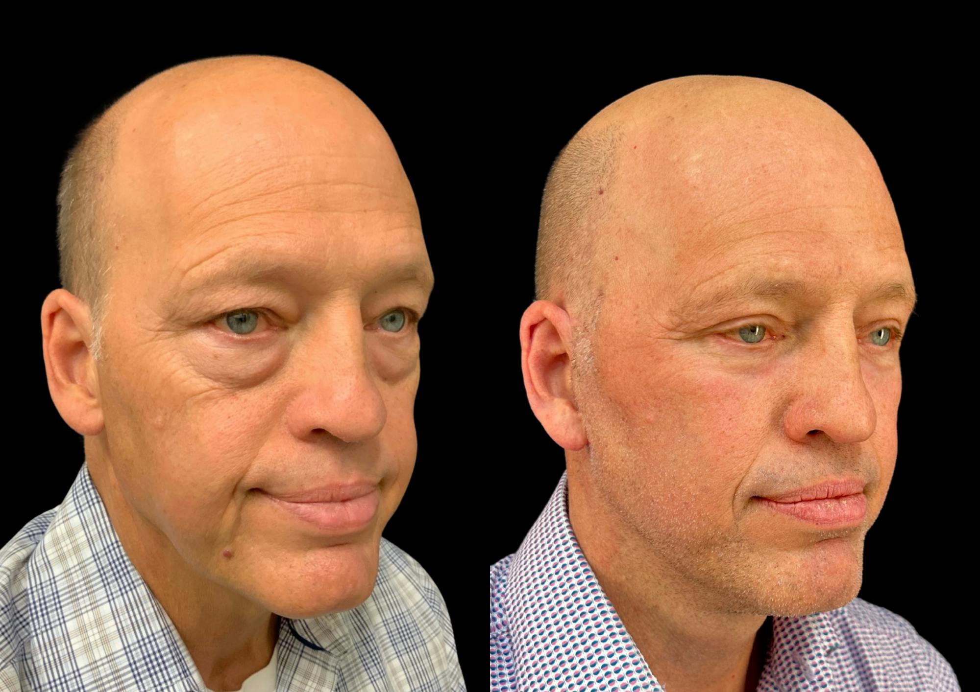 Neck Lift Before & After Gallery - Patient 257148 - Image 5
