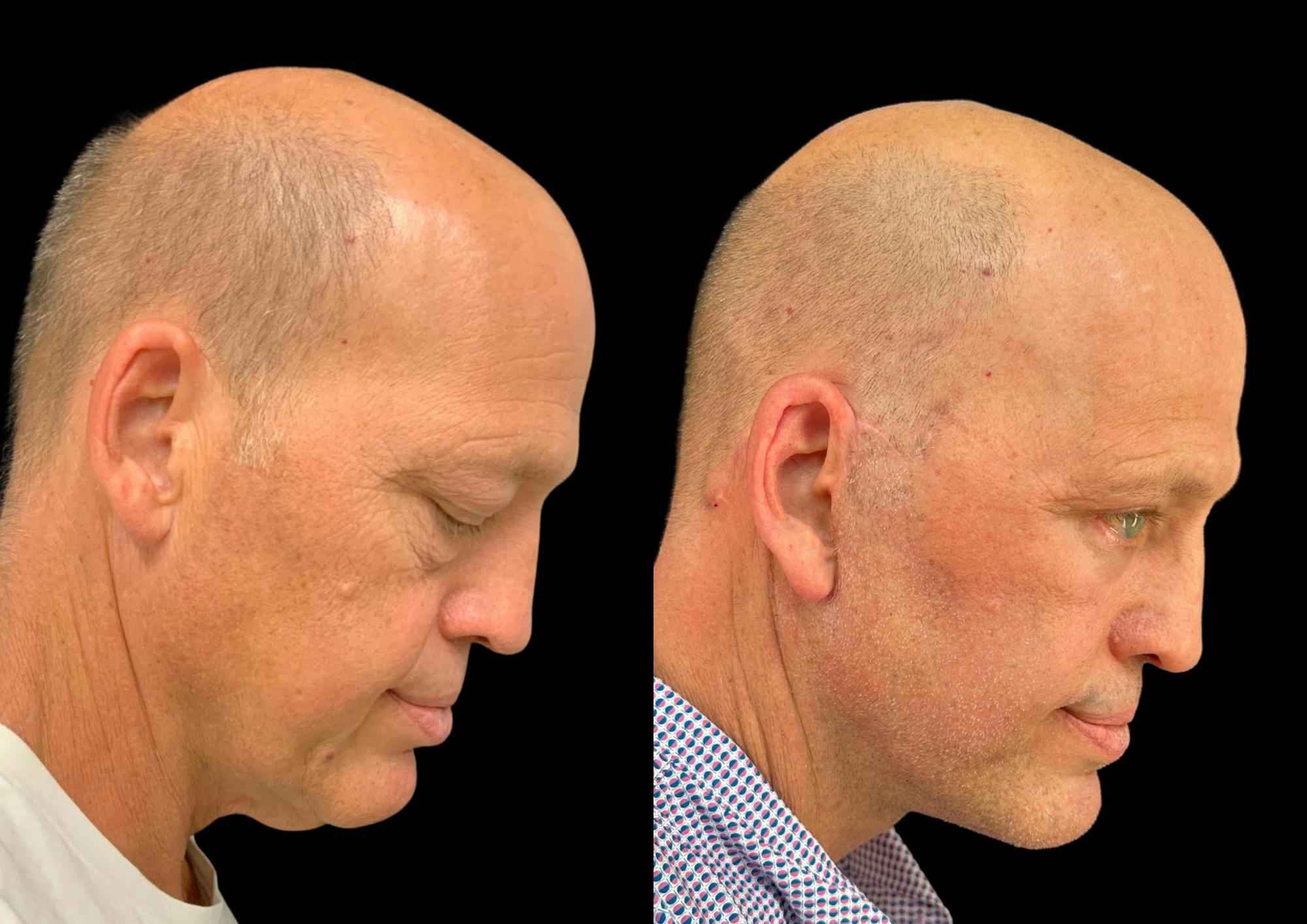 Neck Lift Before & After Gallery - Patient 257148 - Image 7