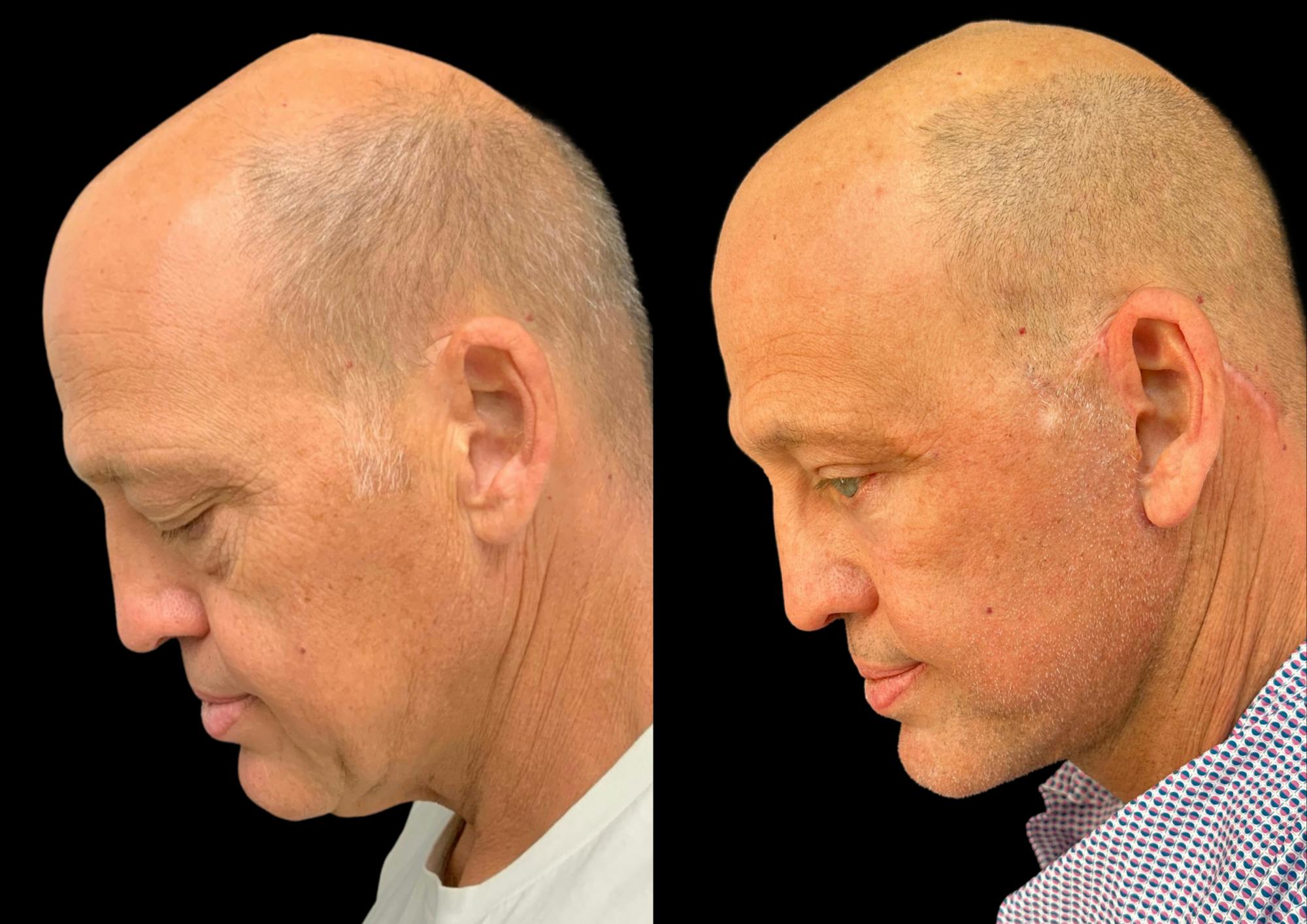 Neck Lift Before & After Gallery - Patient 257148 - Image 2