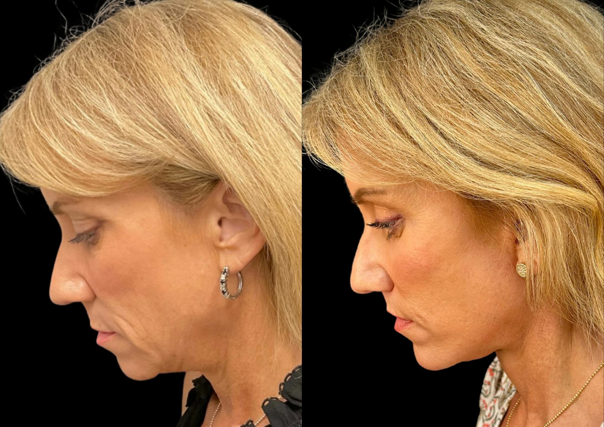 Brow Lift Before & After Gallery - Patient 361927 - Image 2