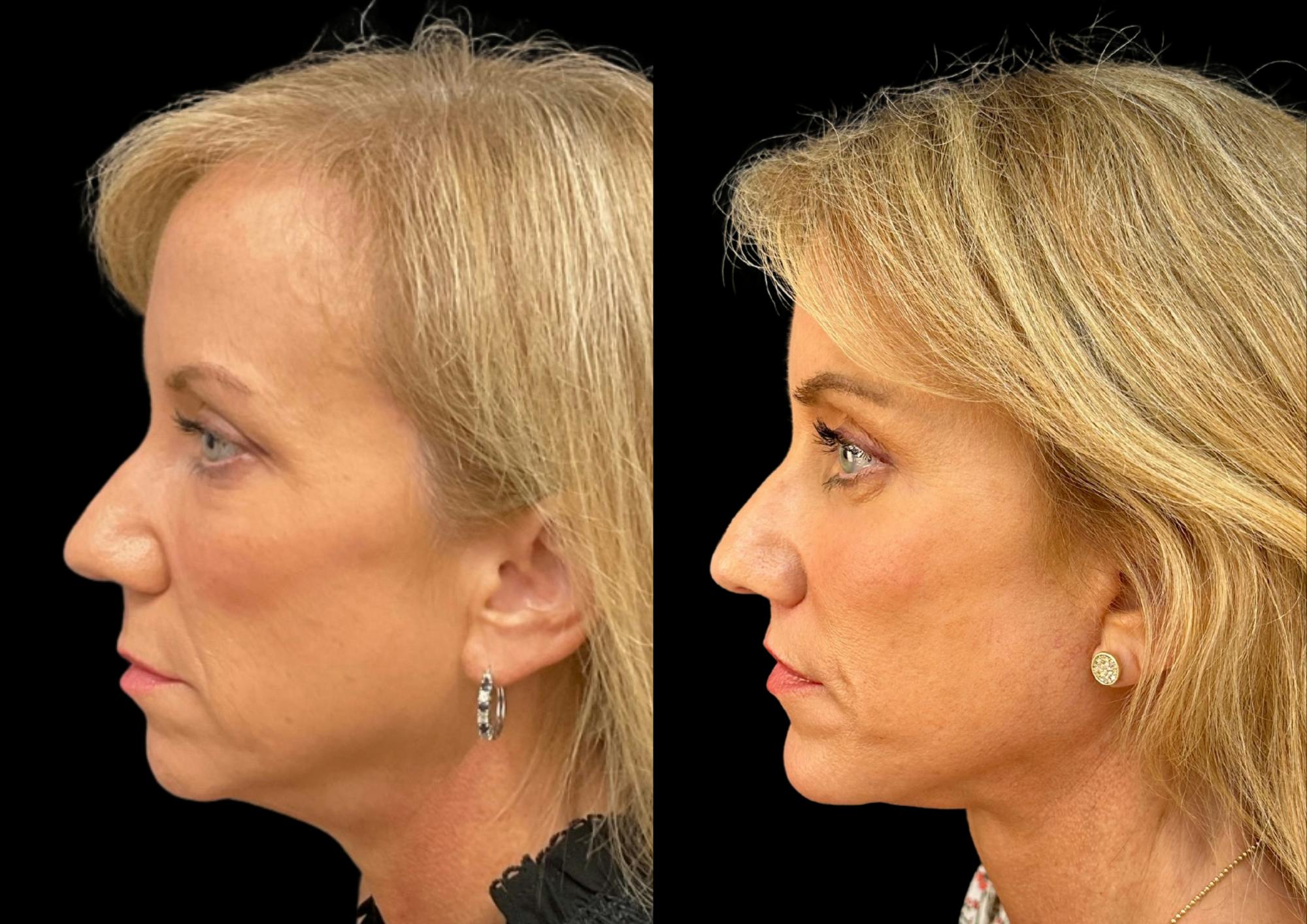 Brow Lift Before & After Gallery - Patient 361927 - Image 3