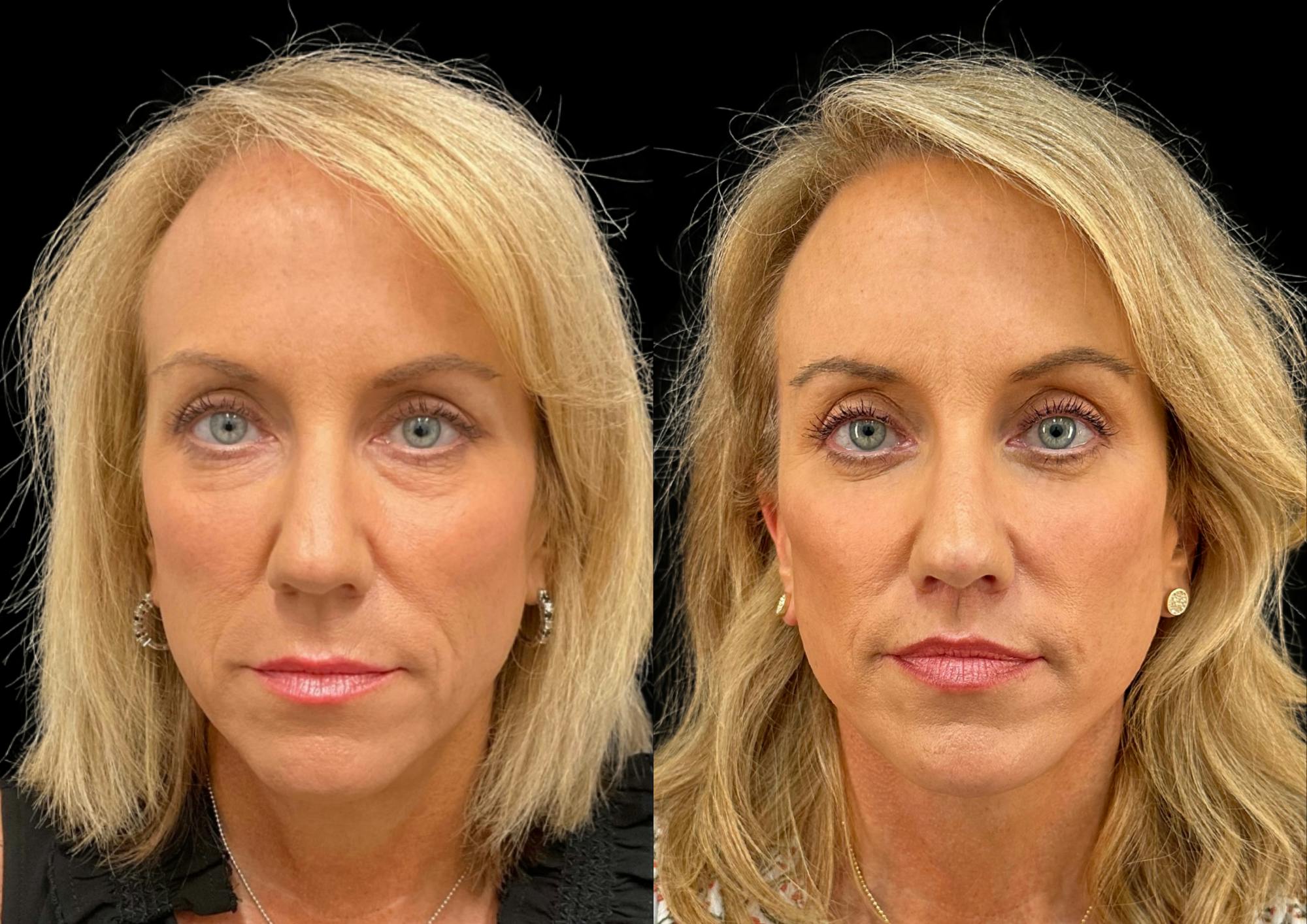 Brow Lift Before & After Gallery - Patient 361927 - Image 1