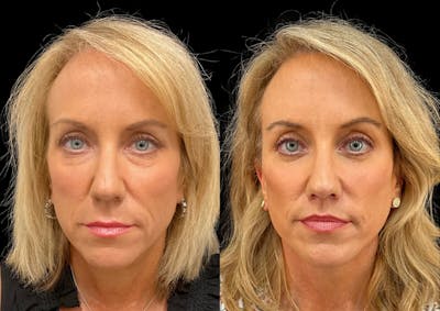 Lip Lift Before & After Gallery - Patient 334534 - Image 1