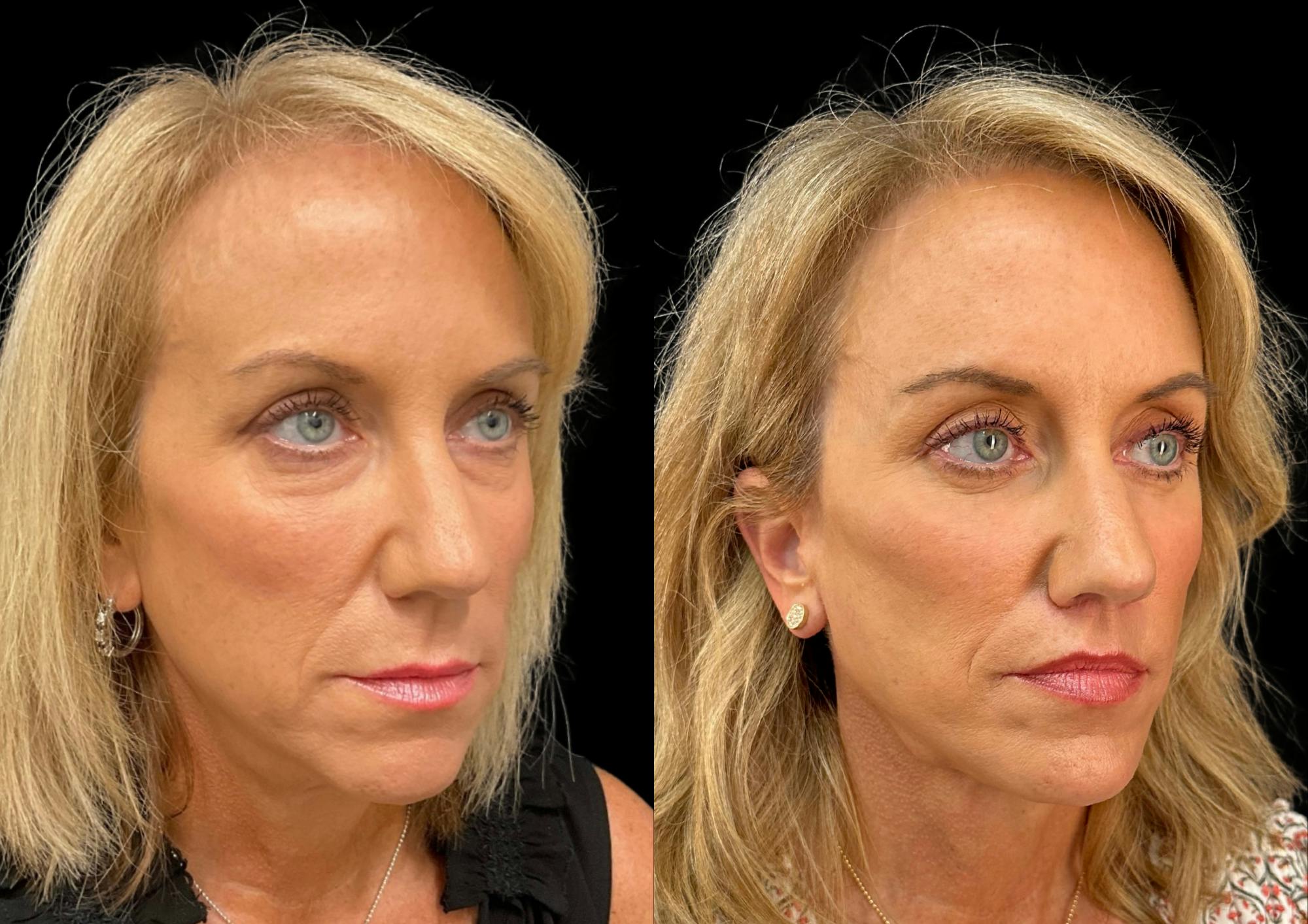 Brow Lift Before & After Gallery - Patient 361927 - Image 5