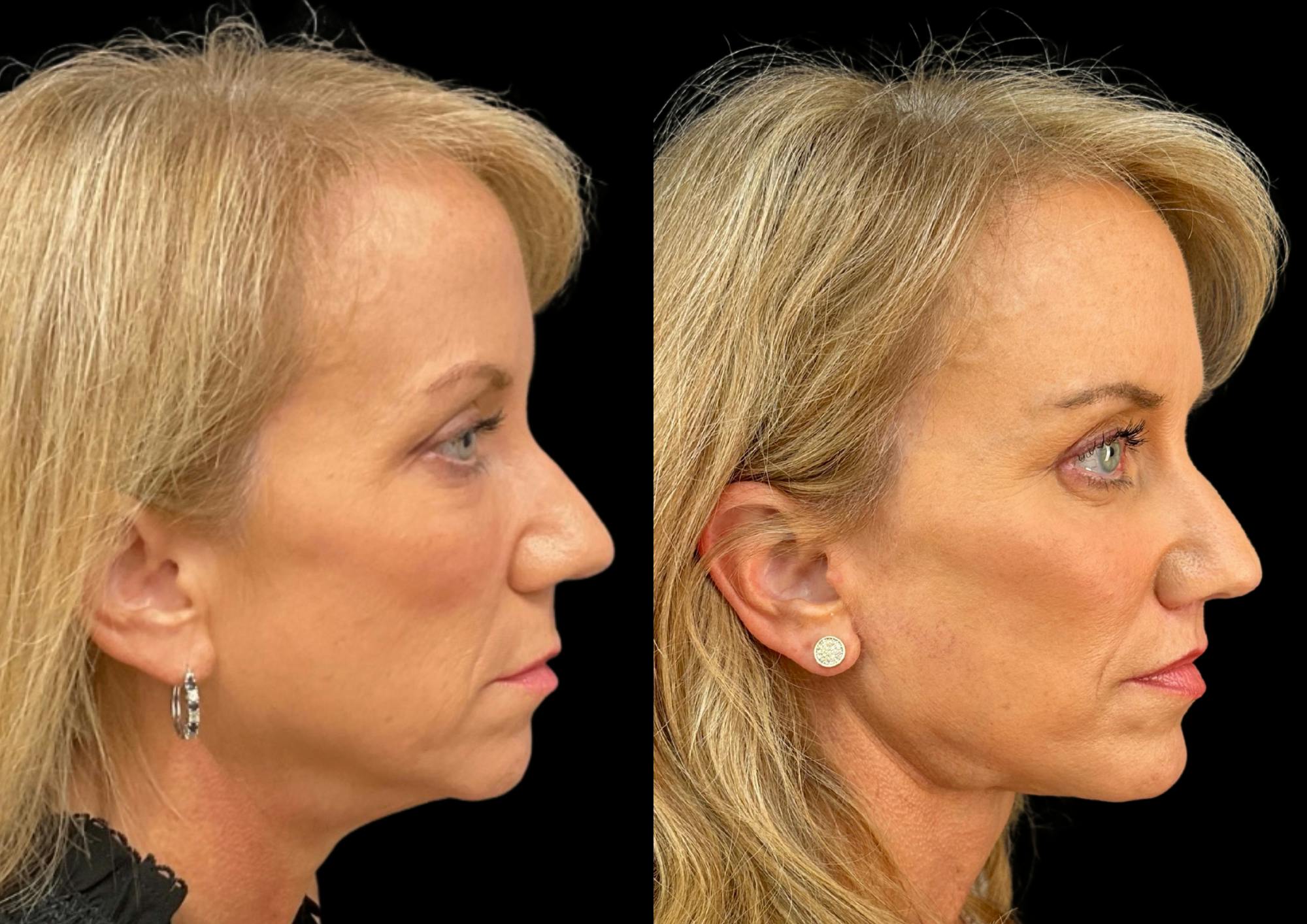 Brow Lift Before & After Gallery - Patient 361927 - Image 6
