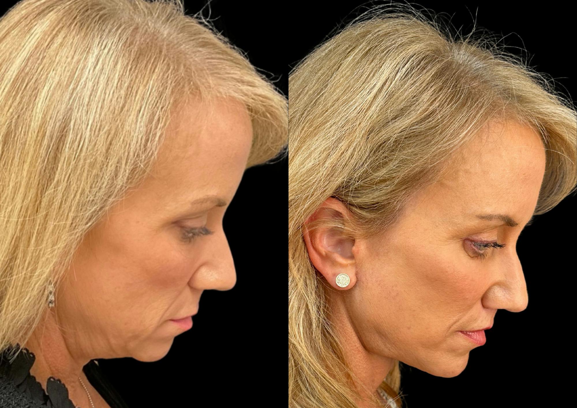 Brow Lift Before & After Gallery - Patient 361927 - Image 7