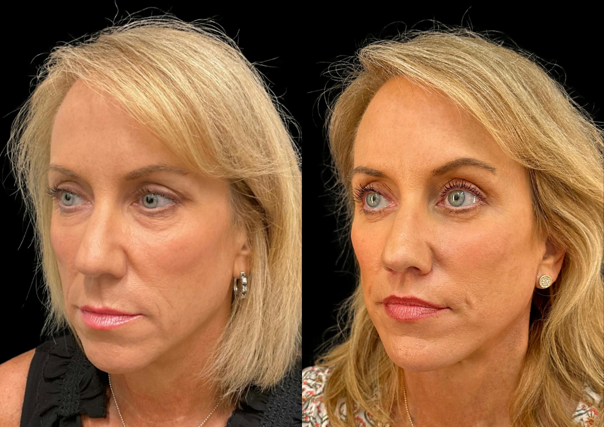 Brow Lift Before & After Gallery - Patient 361927 - Image 4
