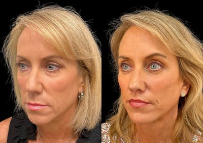 Facelift Before & After Gallery - Patient 296007 - Image 1