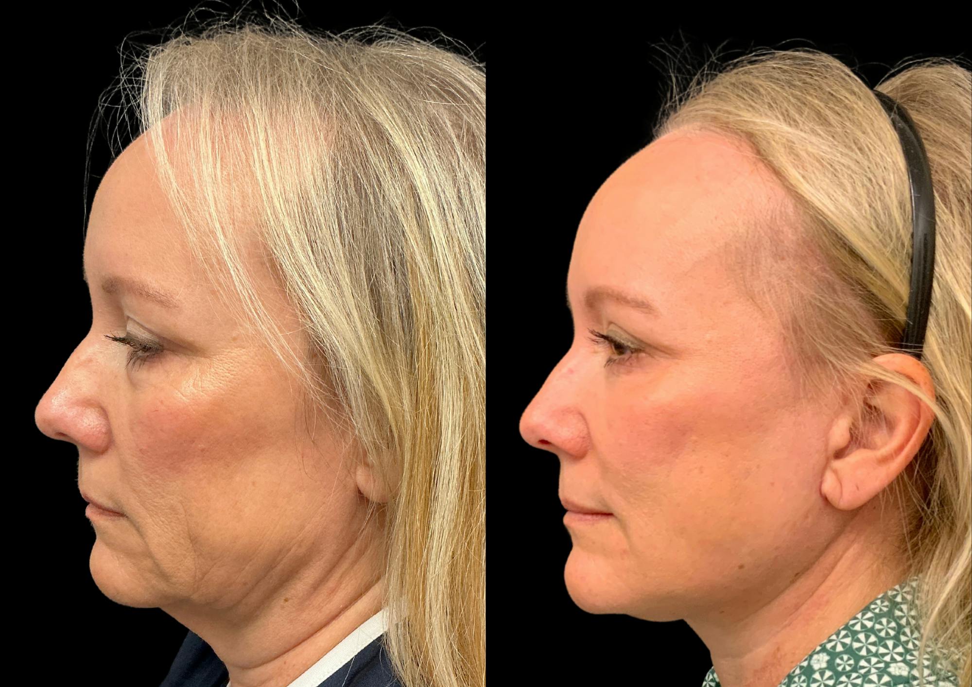 Neck Lift Before & After Gallery - Patient 283298 - Image 1