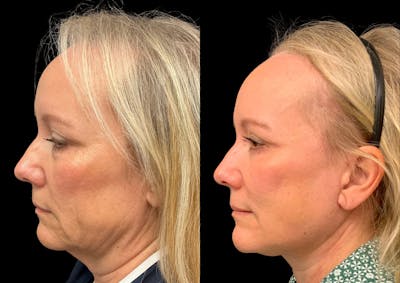 Neck Lift Before & After Gallery - Patient 283298 - Image 1