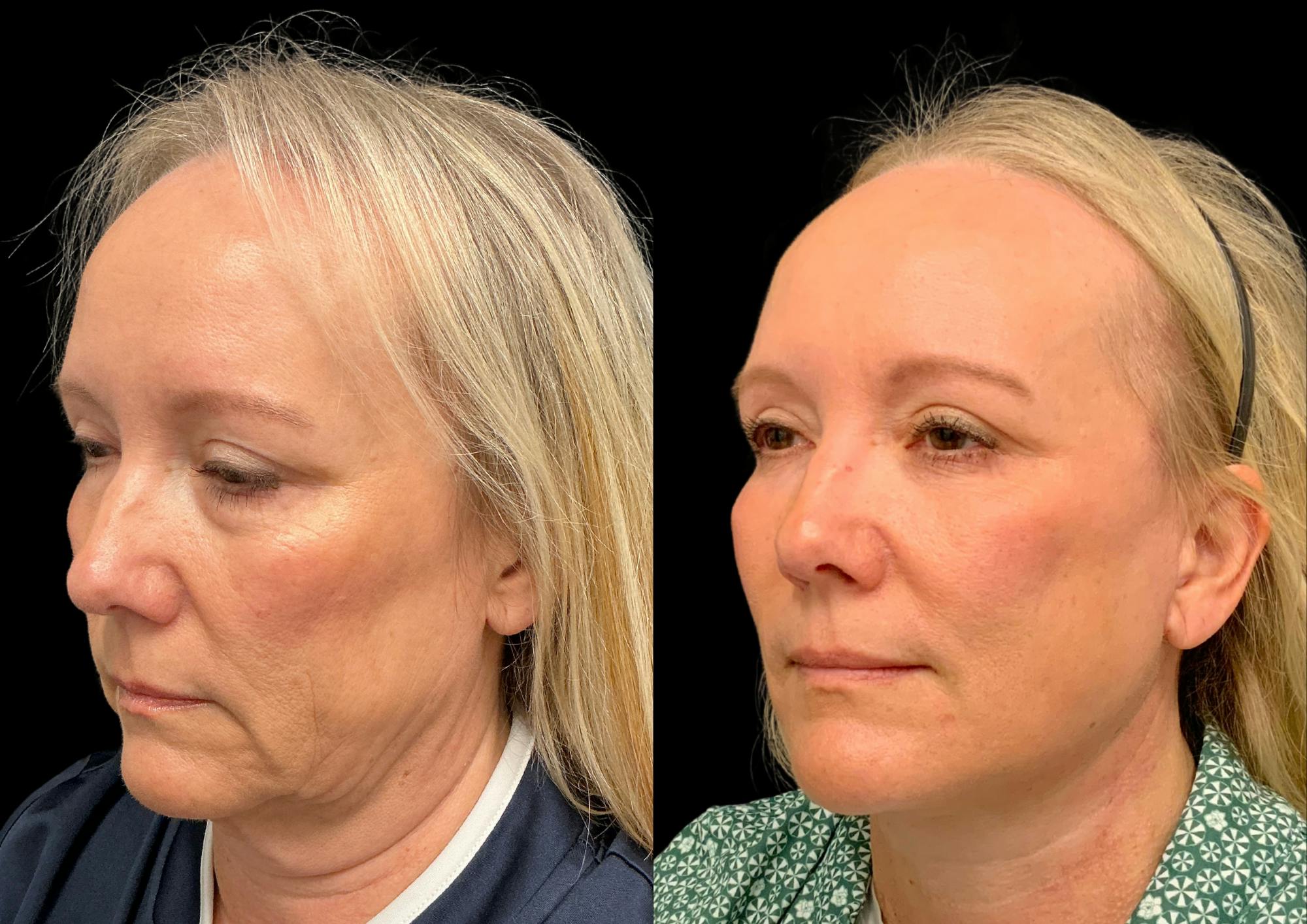 Neck Lift Before & After Gallery - Patient 283298 - Image 3