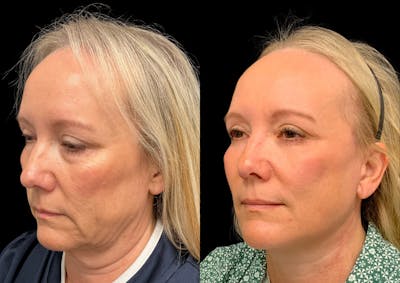 Facelift Before & After Gallery - Patient 235528 - Image 1