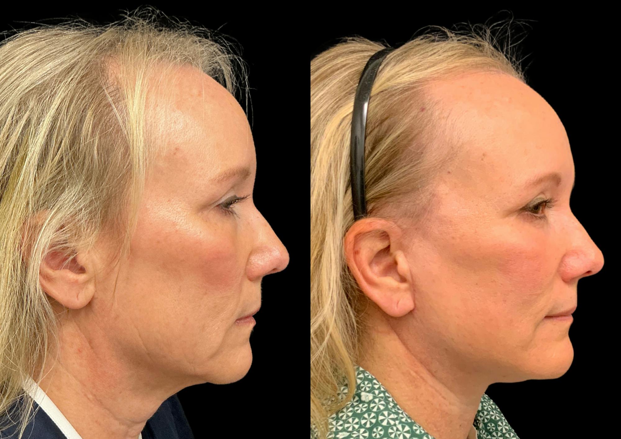 Neck Lift Before & After Gallery - Patient 283298 - Image 6