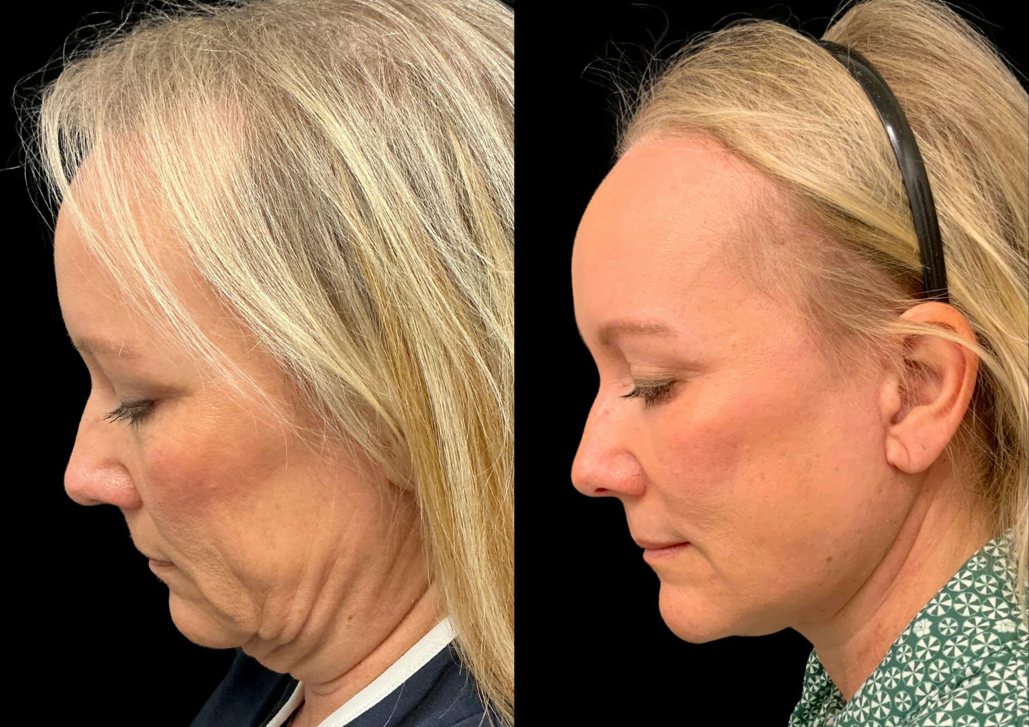 Neck Lift Before & After Gallery - Patient 283298 - Image 2