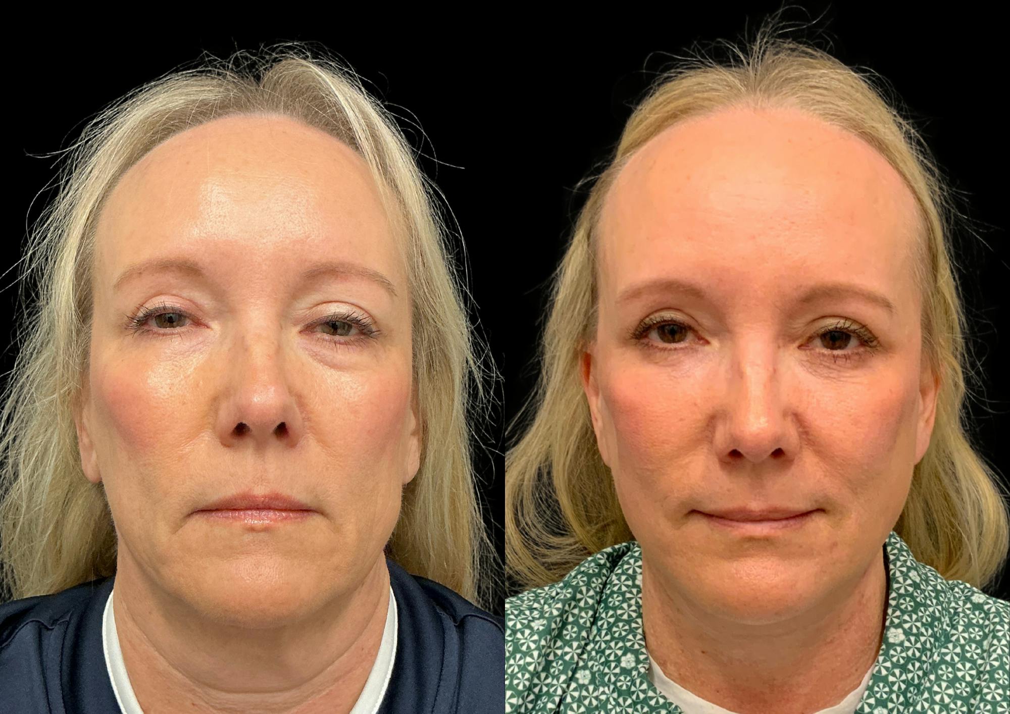 Neck Lift Before & After Gallery - Patient 283298 - Image 4