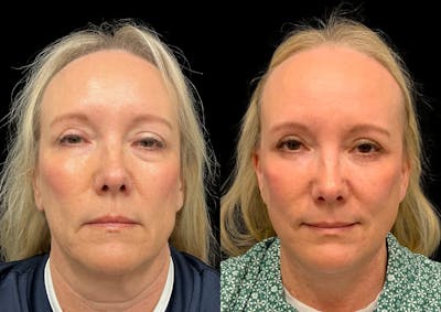 Laser Skin Resurfacing Before & After Gallery - Patient 156098 - Image 1