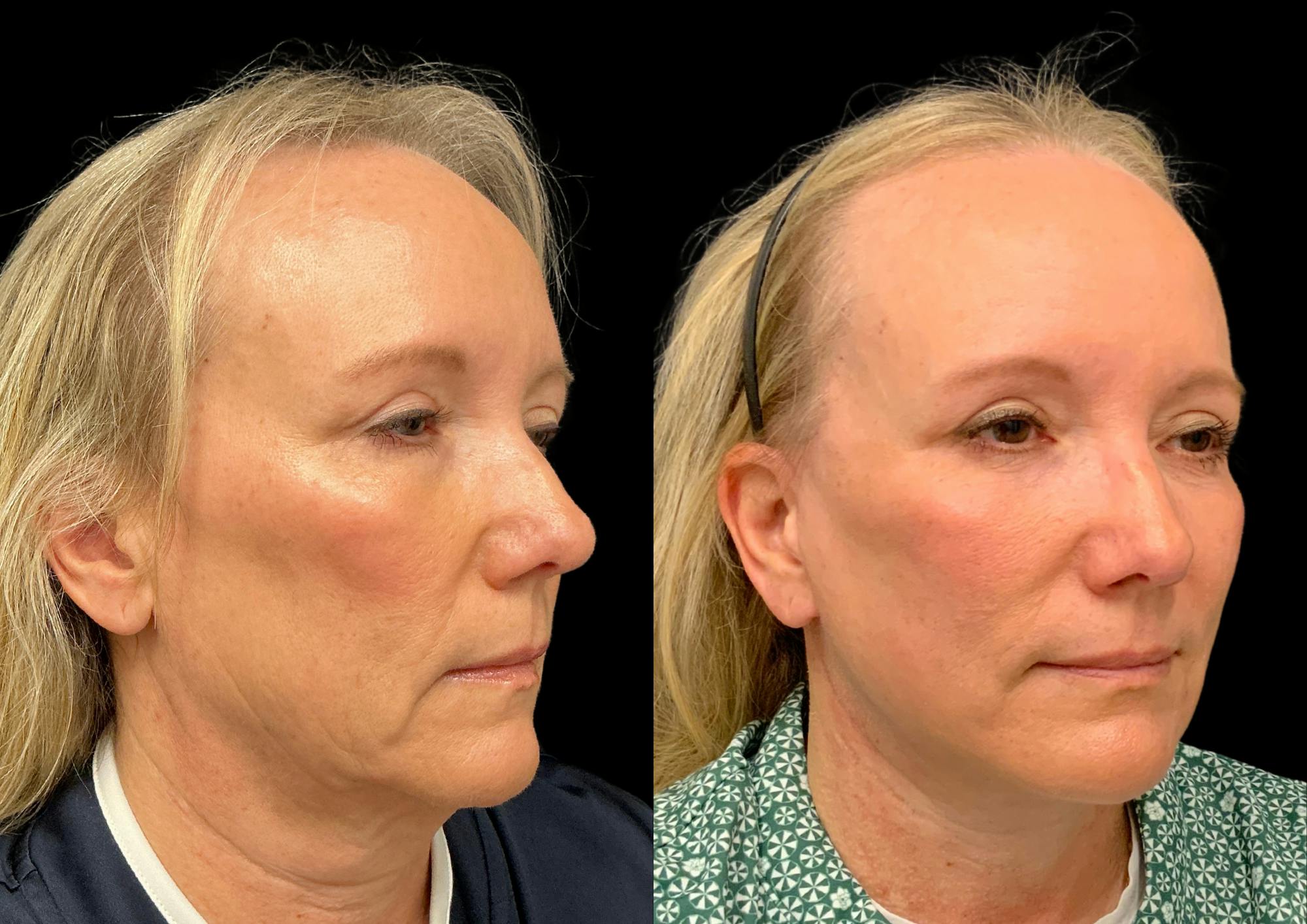Neck Lift Before & After Gallery - Patient 283298 - Image 5