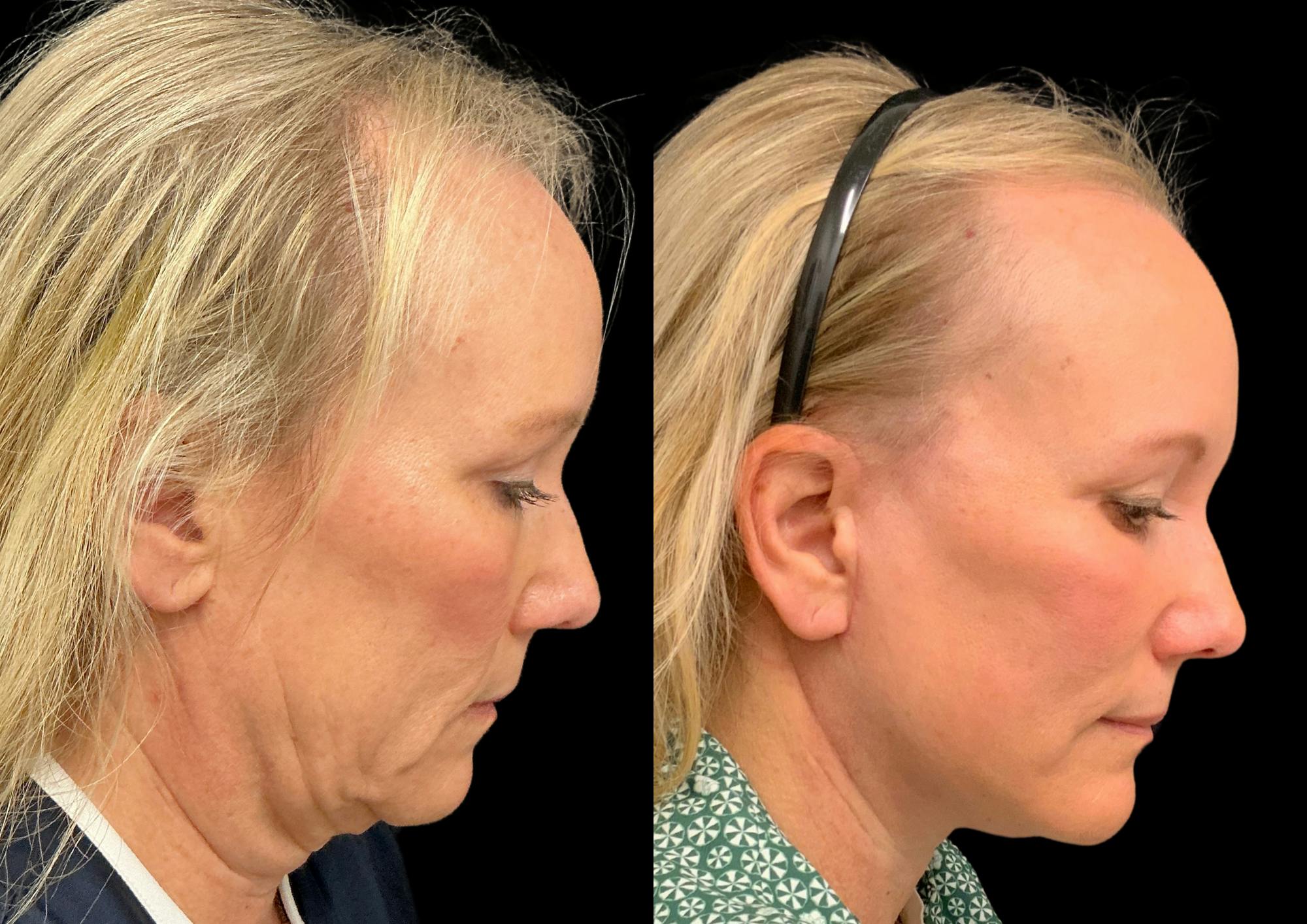 Neck Lift Before & After Gallery - Patient 283298 - Image 7