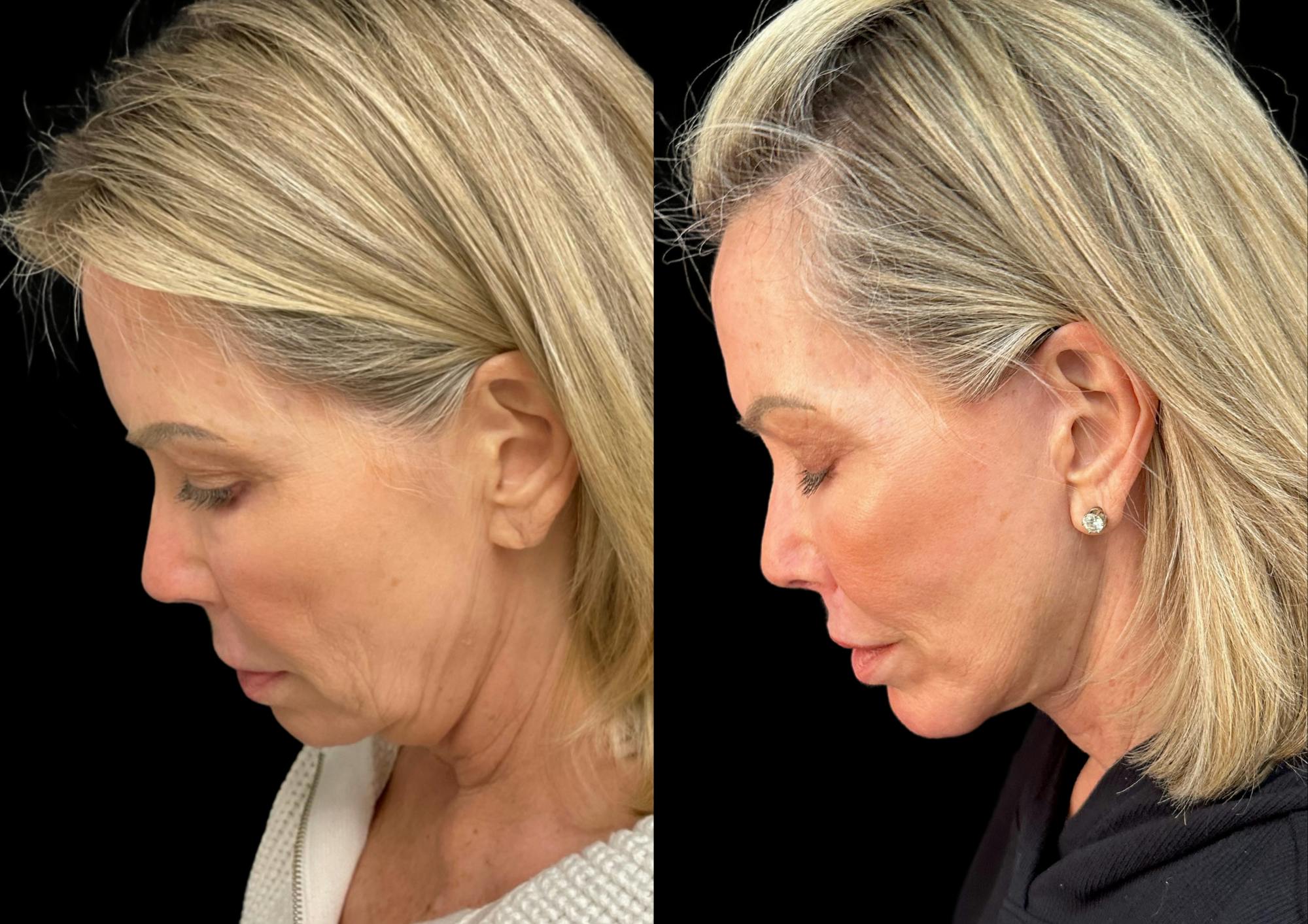 Neck Lift Before & After Gallery - Patient 320535 - Image 2