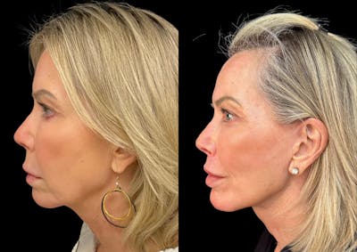 Neck Lift Before & After Gallery - Patient 320535 - Image 1